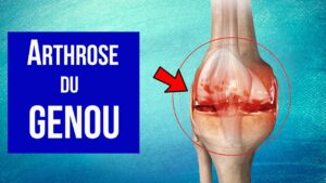 L'arthrose est la maladie articulaire la plus fréquente. Il s'agit d'un rhumatisme dégénératif causé par une destruction progressive du cartilage, entraînant des douleurs et une perte de mobilité.
