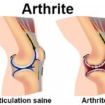 arthrite est une inflammation d'une ou plusieurs articulations. Contrairement à l'arthrose (usure mécanique), les symptômes de l'arthrite surviennent souvent au repos, notamment la nuit ou au petit matin