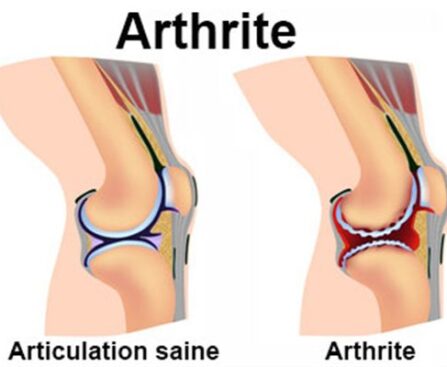 arthrite est une inflammation d'une ou plusieurs articulations. Contrairement à l'arthrose (usure mécanique), les symptômes de l'arthrite surviennent souvent au repos, notamment la nuit ou au petit matin