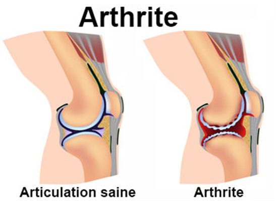 arthrite est une inflammation d'une ou plusieurs articulations. Contrairement à l'arthrose (usure mécanique), les symptômes de l'arthrite surviennent souvent au repos, notamment la nuit ou au petit matin